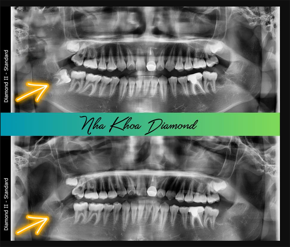 Ca nhổ RĂNG 48 mọc lệch ngầm Nha Khoa Dental Daimond II Phước An