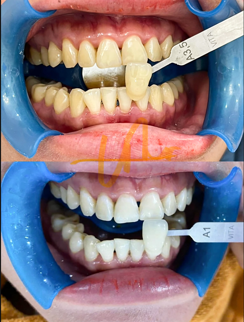 Tẩy trắng răng tại Phước An