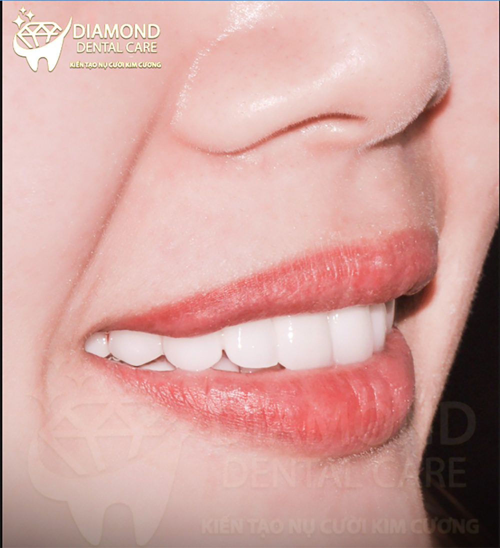 Thẩm mỹ răng sứ Nha Khoa Dental II Phước An